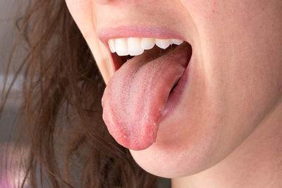 舌痛症とは
