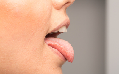 舌の痛みを起こす原因