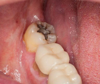取れた銀歯の内面が真っ黒になっている場合の原因は何？